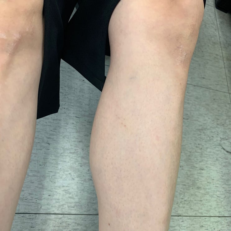  하체부종에 특출난 효과가 있다는 제품, 셀루라인
