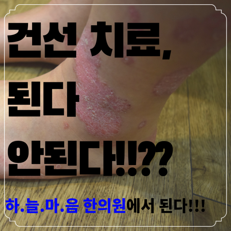 대전 건선 / 각질이 후두둑, 건선의 원인과 치료법을 알아보자~~!!