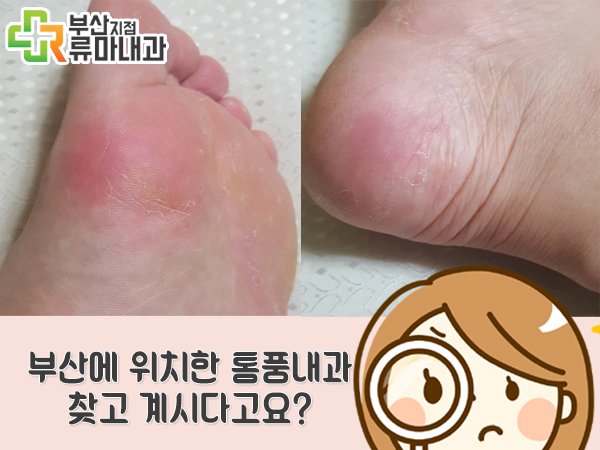  부산 창원 김해 엄지발가락 통증 정말 통풍일까?