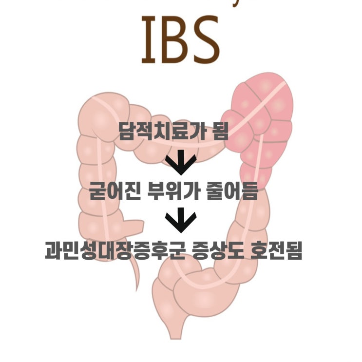  과민대장증후군은 이렇게 치료하세요