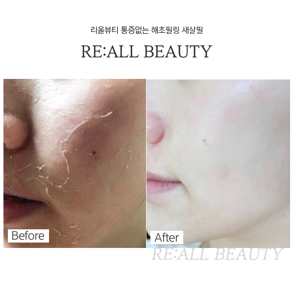  [강남에스테틱] 통증없이 진행하는 피부박피 해초필링 새살필 가격/ 후기