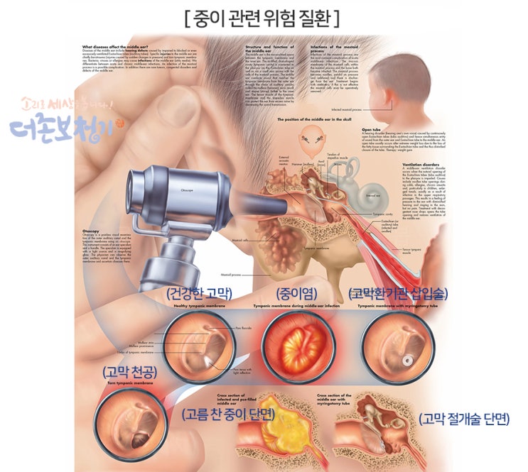  전음성 난청의 원인, 외이와 중이 질환