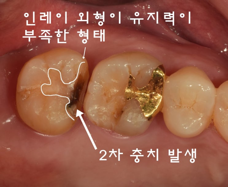 구산동치과금으로 떨어뜨린곳이 떨어져 가지고 왔으나 적합하지 않아 재제작한경우 및 골드인레이가격
