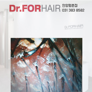  범계탈모 한계가 넘엇어