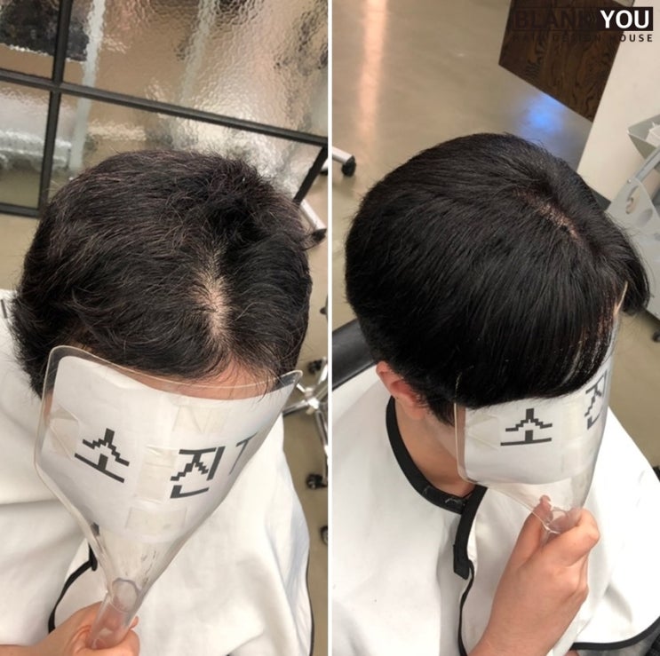 분당 항암탈모 5개월 짧은앞머리 길이연장 증모술 블랭크유