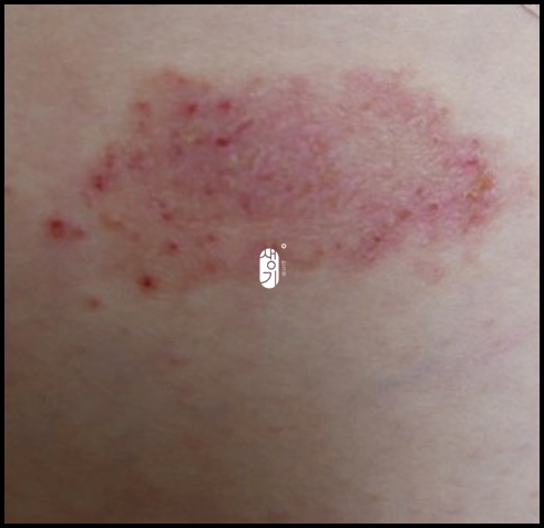  발바닥습진 무좀은 아닌데 가렵다면!