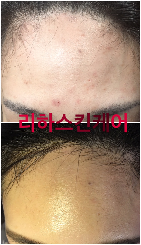  관악구 동작구 서울대입구 봉천역 숭실대입구 상도역 여드름 전후사진 리하스킨케어