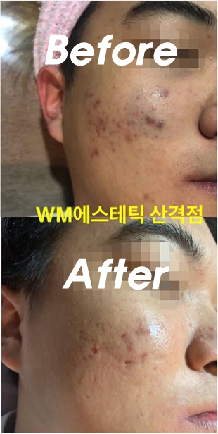  사춘기 여드름 트러블 관리 전후 더블유엠산격점