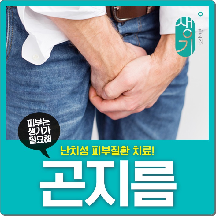  항문곤지름 방안을 찾아보면