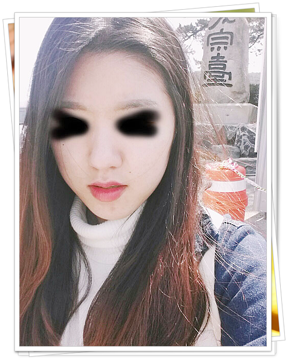  여드름색소침착레이저 없이 가능했던 리얼 치료후기.