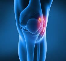 무릎 뼈주사(스테로이드)의 부작용. 오히려 관절염이 악화된다?