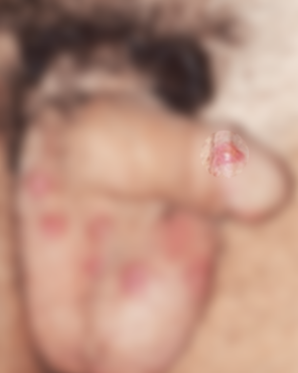 울산성병검사] 남자 귀두 및 성기 붉은 반점의 원인- 옴진드기 감염의 증상과 치료 : 네이버 블로그
