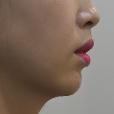광주턱보톡스 무턱라인과 사각턱까지 문제없는 잘하는곳 13