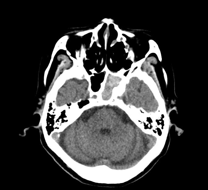 영상퀴즈: 두부 외상으로 내원한 환자의 brain CT : 네이버 블로그