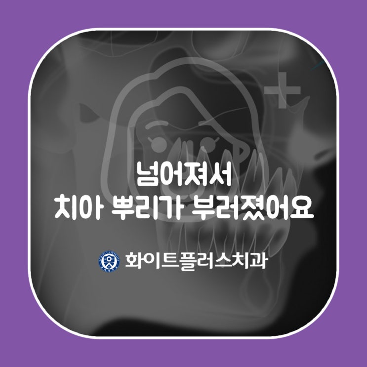  다쳐서 치아 뿌리가 부러졌어요 / 신길동치과