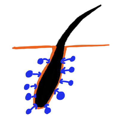 [삼성동피부과] 원형탈모, 남성형탈모, 여성형탈모 구분하기(원인 및 치료) - 피부과 전문의 닥터림