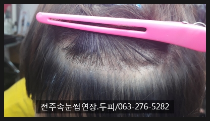 #정수리탈모 에 새로운 탈모치료 짱! #정수리탈모 에 새로운 탈모치료 짱!