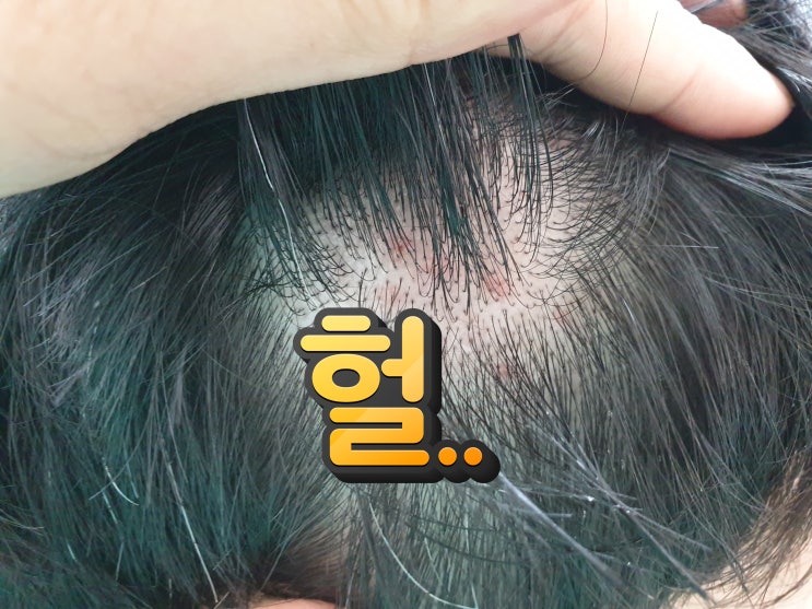  두피 뾰루지 샴푸 잘못고르면 머리빠지는갯수 차이 엄청남