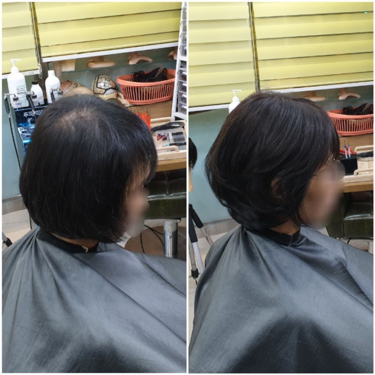  두피샴푸 가능해서 넘 좋아요~ #헤어이식커버증모로 탈모탈출~^^