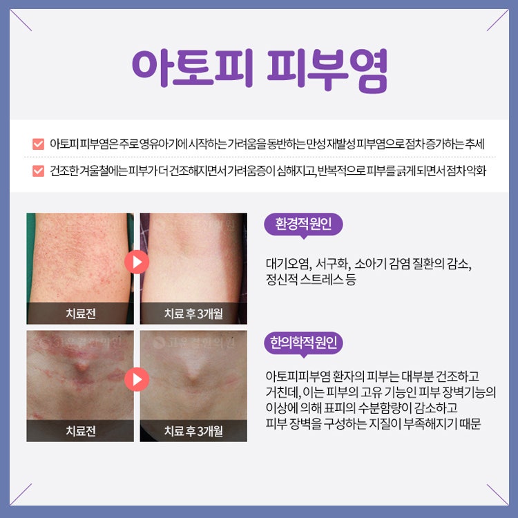 영등포 아토피 피부염 엄선