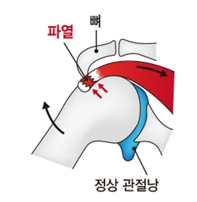  어깨질환종류와 증상 간단 요약 - 어깨 회전근개파열, 어깨충돌증후군, 오십견