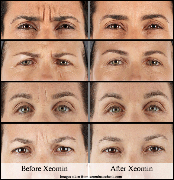 눈가 주름, 입술 주름, 입가 주름, 이마 주름 및 목 주름을 제거하는 방법