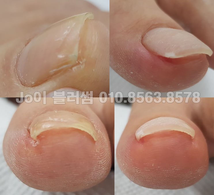  발톱이 파고들고 들떠서 관리받고 싶으신 고객님을 위한 네일샵 추천 조이블러썸