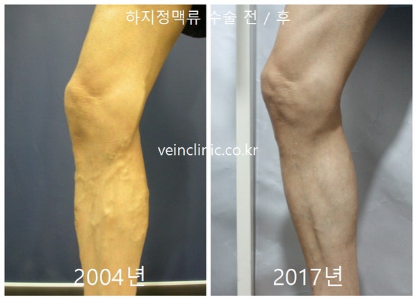 강남흉부외과추천 하지정맥 레이저수술(EVLT) 특징은? 2