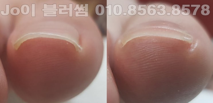  용인 파고드는발톱은 예비신랑도 벗어날수 없습니다. 관리 네일샵 조이블러썸에서 발톱관리