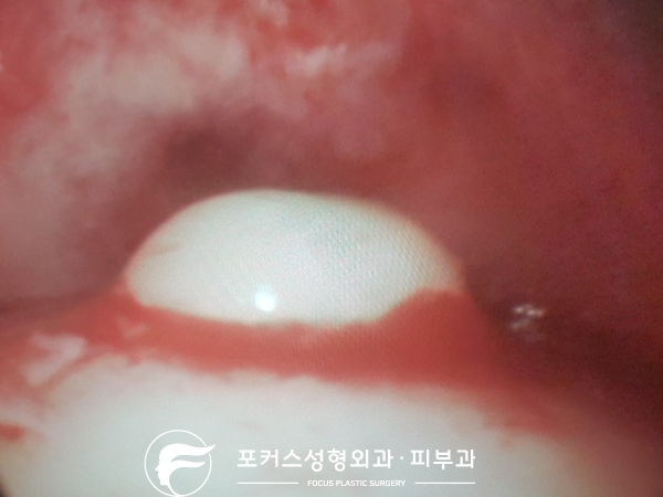 인천이마골종 - 이마의 혹 제거 인천이마골종 - 이마의 혹 제거