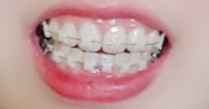  d+240 교정일기 mcpp장치제거 +철사교체