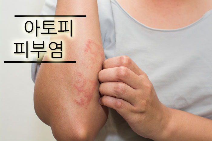  강남역 피부과 '아토피 피부염 Atopic dermatitis'