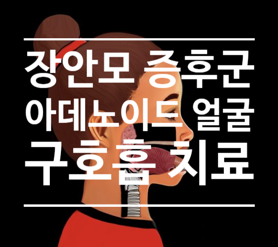 장안모증후군/아데노이드얼굴로 나타나는 성장기 아동의 구호흡 - 예방과 치료