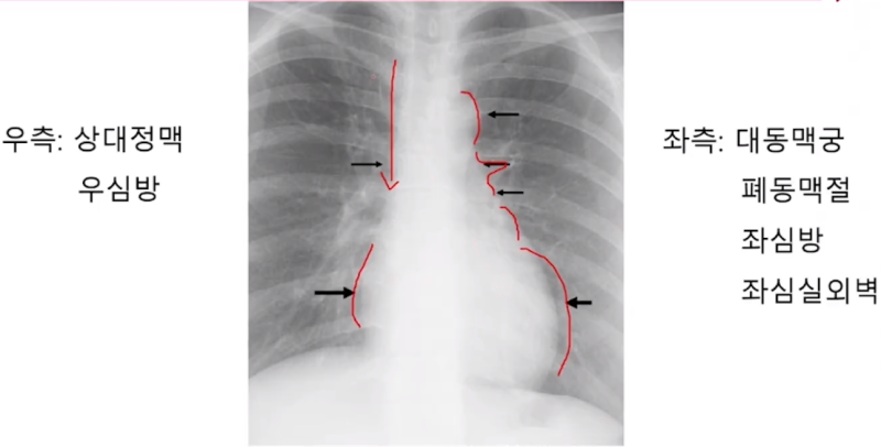 정상 흉부 X선 사진 (X-ray) 해부학 구조, 기본 판독 방법 : 네이버 블로그