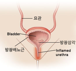  여자 방광 위치 '골반 내 치골결합 뒤쪽'