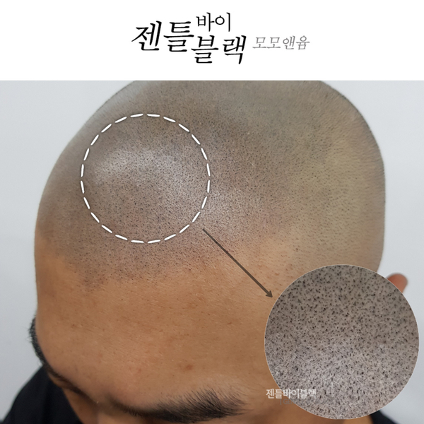  [젠틀바이블랙-두피타투] 남성미 뿜뿜하는 두피삭발타투_SMP/강남두피타투/헤어라인타투/대머리디자이너_반야