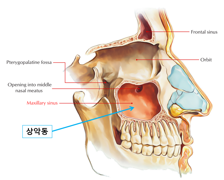  천안사랑니 | 사랑니 발치시 주의_두번째, 상악동천공