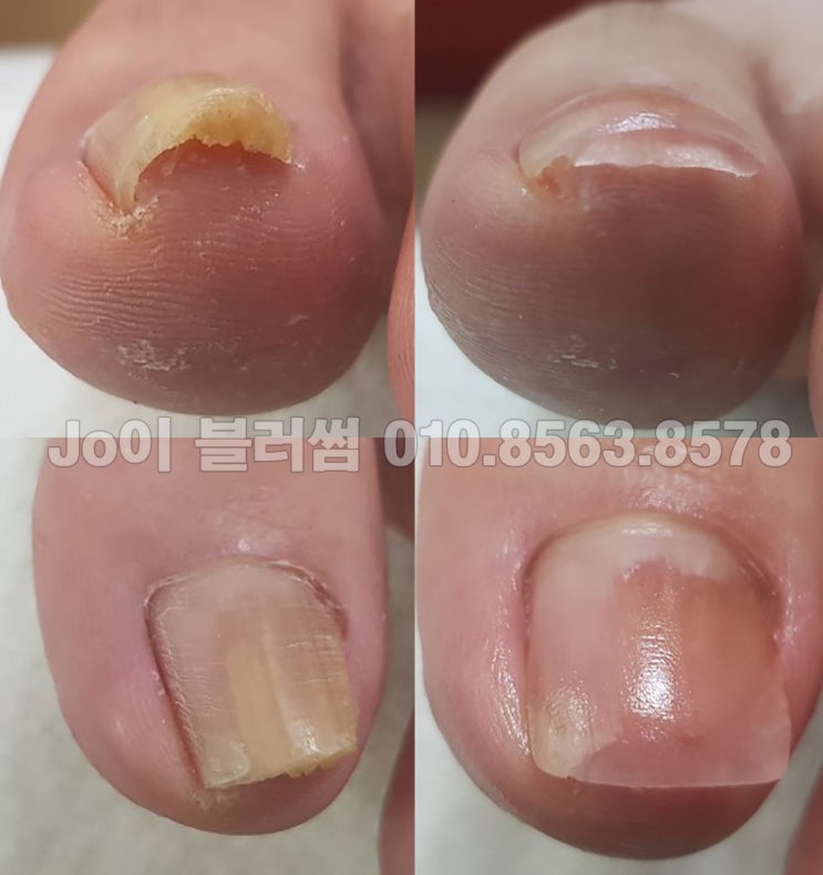  용인 무좀 발톱, 발톱이상증상, 파고드는 발톱 관리 전문 네일샵 조이블러썸