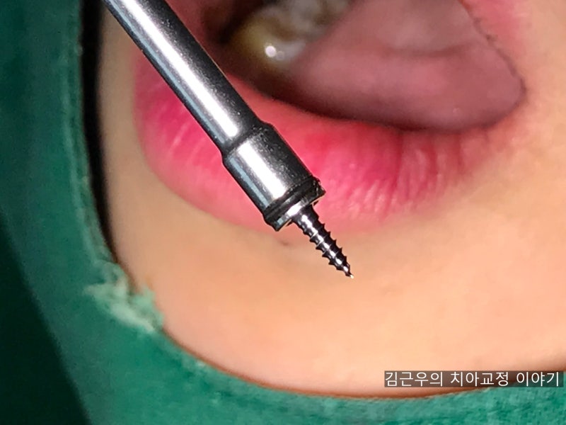 치아교정 스크류 통증 : 네이버 블로그 치아교정 스크류 통증 : 네이버 블로그
