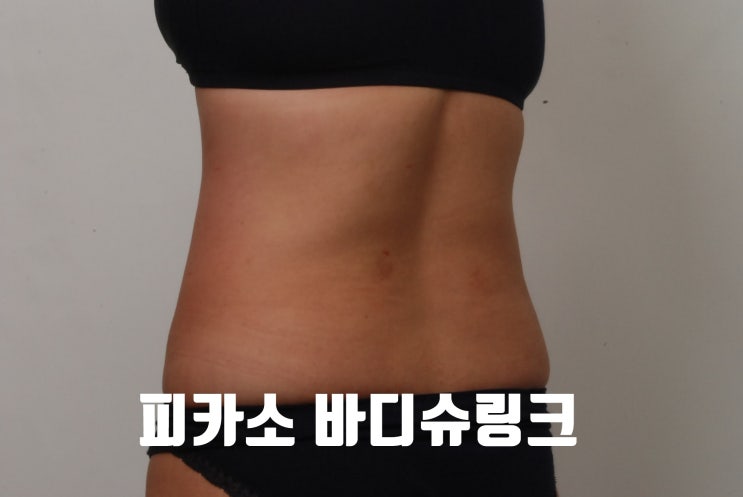  바디슈링크 후기, 출산후비만치료 복부 허벅지살리프팅 효과 알기