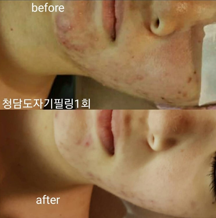  대구 여드름 트러블 피부 관리는 역시 더블유엠에스테틱 !!!
