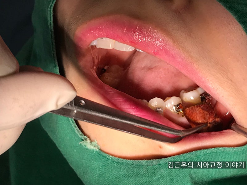 치아교정 스크류 통증 : 네이버 블로그 치아교정 스크류 통증 : 네이버 블로그