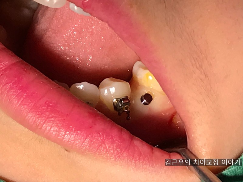 치아교정 스크류 통증 : 네이버 블로그