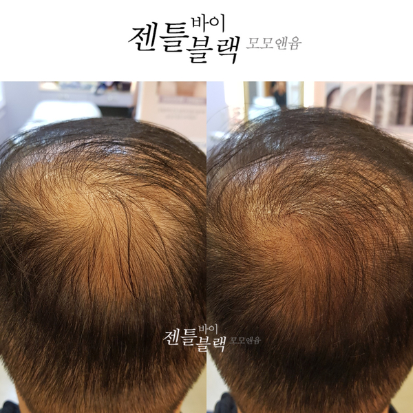  [젠틀바이블랙-정수리탈모커버] 탈모가 젊어지고 있다!! - 20~30대 남성탈모/탈모처방/출산 후 탈모