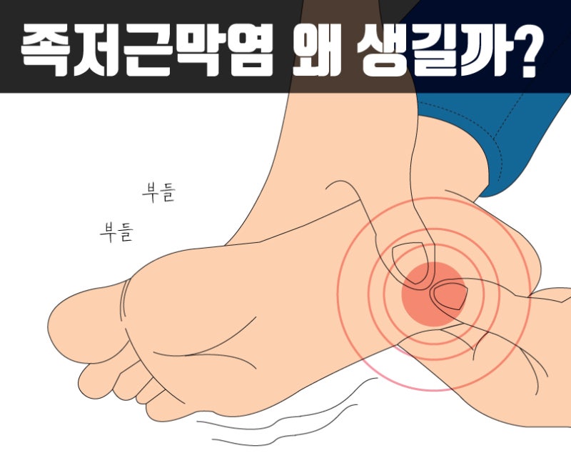 대구걷을때 톡/족저근막염/발바닥통증/체외충격파/물리치료/주사치료/죽전동사랑모아마취통의학과의원