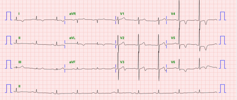 심근경색 (Myocardial infarction),LCX MI : 네이버 블로그