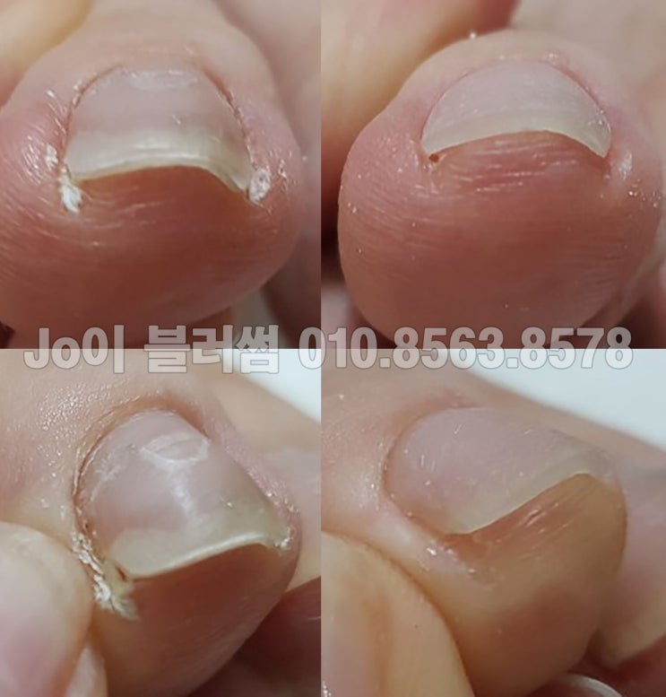  용인 발톱무좀, 파고드는 발톱, 발톱 이상, 손톱이상 관리 네일샵