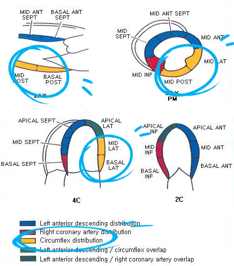 심근경색 (Myocardial infarction),LCX MI : 네이버 블로그