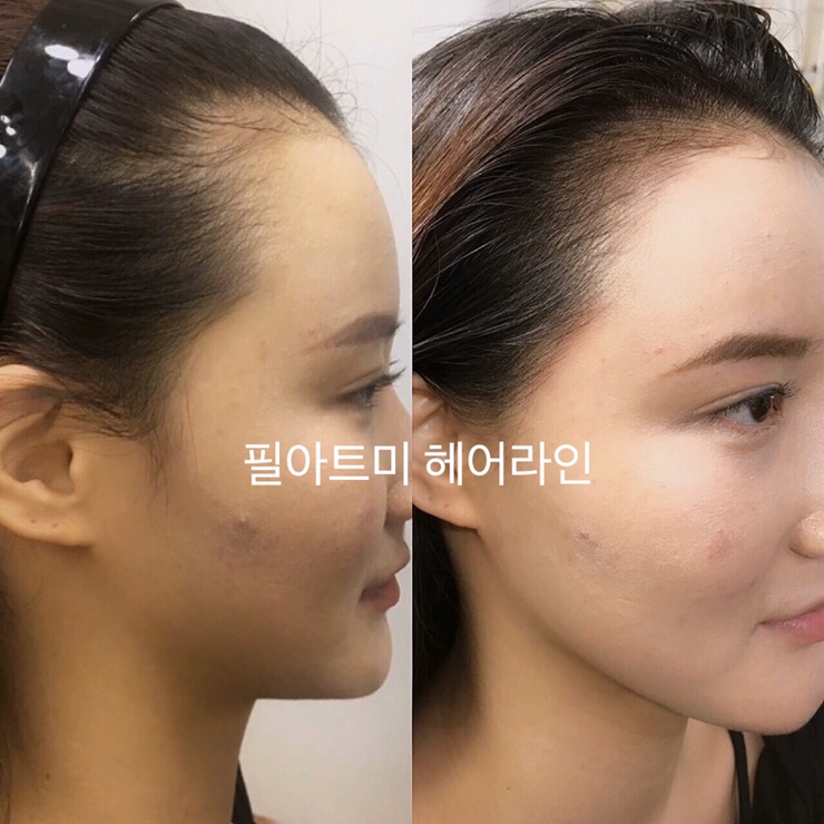  논현역 헤어라인문신 감쪽같이 채워진 옆머리 빈 곳