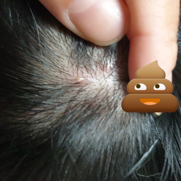 머리 안감으면 탈모 옵니다... 본인경혐담